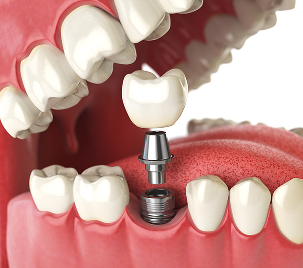 Simi Valley Will I Need a Bone Graft for Dental Implants