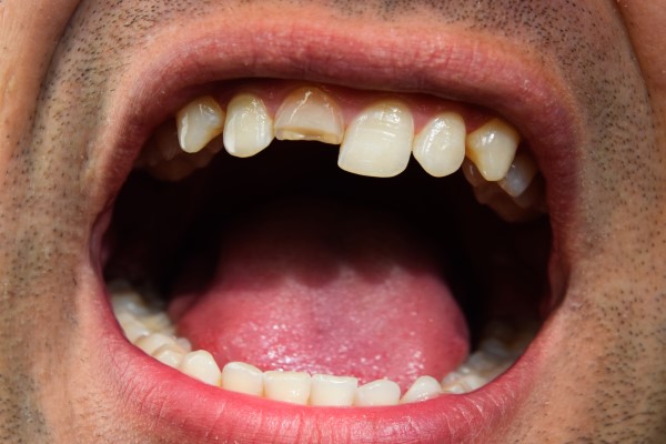 What To Do When You Have A Chipped Tooth