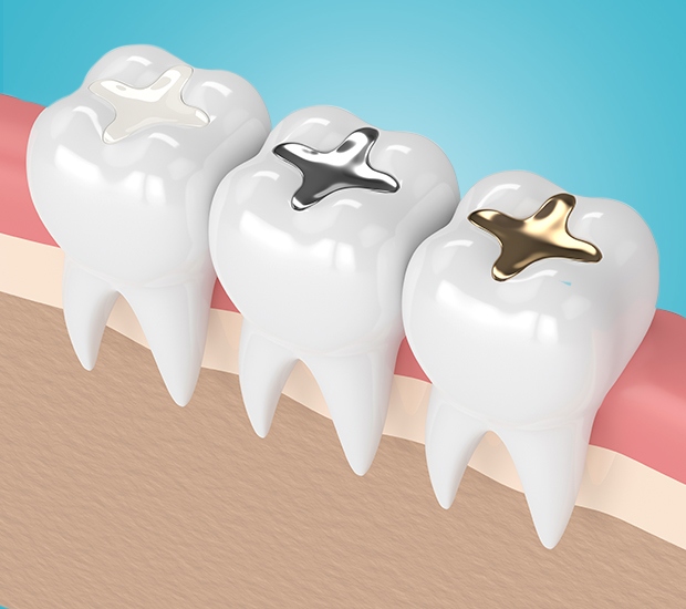 Simi Valley Composite Fillings