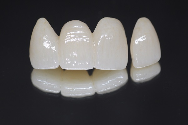 Understanding The Process For Dental Bridges