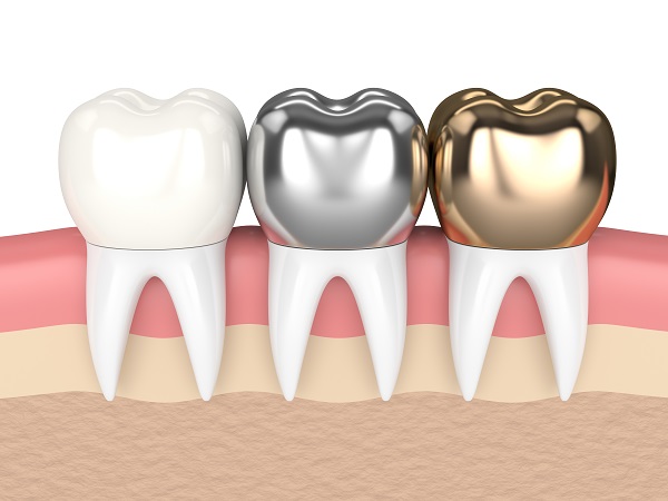 Material Options For Dental Crowns