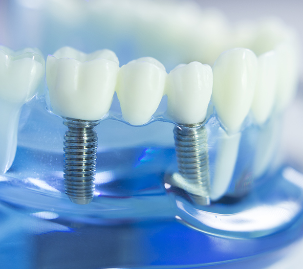 Simi Valley Dental Implants
