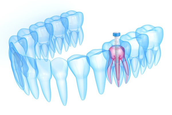 Root Canal Therapy From A General Dentist For A Cracked Tooth